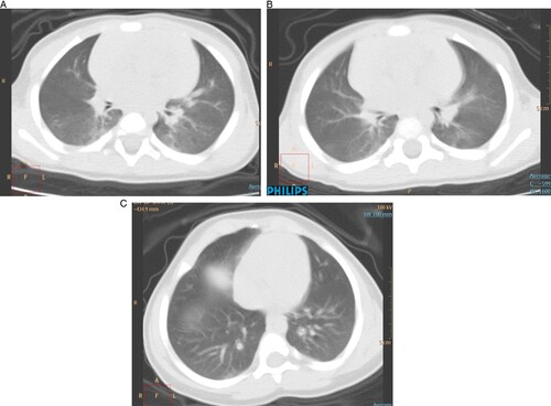 Figure 1: Chest CT images of a case 7 and case 8 (one pair of 11 month old twins) patient upon admission, who had no symptom. (A) Transverse chest CT images showed pulmonary consolidation and ground glass opacity (case 7 on 7 February). (B) Showed marked improvement after 5 days (case 7 on 13 February). (C) Lung CT of case 8 – the case 7’s younger brother on admission day (case 8 on 7 February).