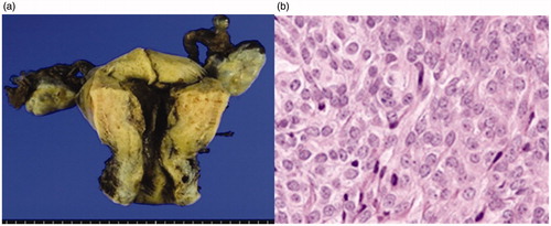 Figure 5. (a) Macroscopic findings of a specimen. Coagulation necrosis due to thermal denaturation of the endometrium and the myometrium is seen. (b) Histopathological image of the endometrium after MEA (HE staining X40). Coagulation necrosis due to thermal denaturation of the endometrium and the myometrium is seen, but only with signs of non-atypical endometrial hyperplasia. MEA: microwave endometrial ablation; HE: hematoxylin-eosin.