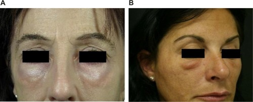 Figure 3 Malar edema.