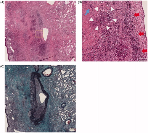 Figure 4. (A) Histopathology of lung lesion in right upper lobe (Hematoxylin and Eosin staining). (B) Higher power field of (A); diffuse infiltration of lymphocytes and necrotizing vasculitis with bronchocentric granulomatosis. Giant cell (blue arrow), inflammatory cells (red arrows), fibrinoid degeneration (circle of white arrowheads). (C) Histopathology of lung lesion in right upper lobe (Elastica Masson staining).