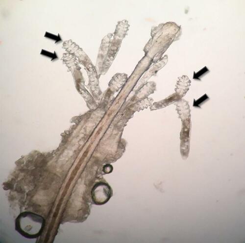 Figure 1 Demodex folliculorum mites on a lash follicle (black arrows).