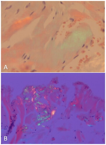 Figure 1. Congo red stain of biopsies under polarized light. Congo red stain with apple-green birefringence under polarized light of bone marrow biopsy (A) and bladder biopsy (B).