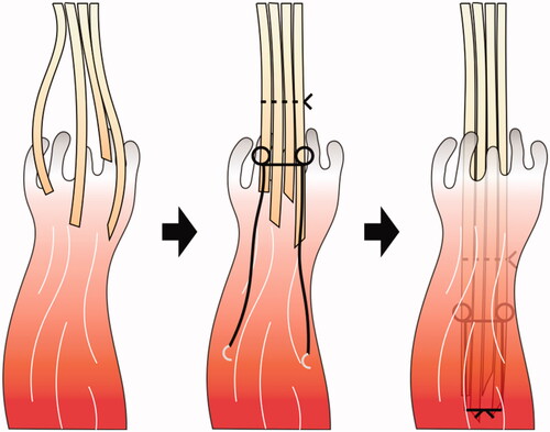 Figure 1. Schematic diagram of a pull-in suture.