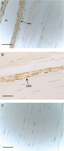 Figure 1. Expression of BMP13 in healthy human patellar tendon as detected by immunohistochemistry. A: Perivascular mesenchymal cells (PMC) near blood vessel (BV); B: Active remodeling regions (ARS). C: Interstitial tenocytes are BMP13-negative (Bar is 50 μm).