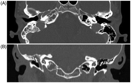 Figure 1. Computed tomography. (a). Horizontal section. (b). Coronal section. Opacification of the right middle ear and the temporal bone air cell system, including the mastoid and pars petrosal, but no destruction of the bony septa.