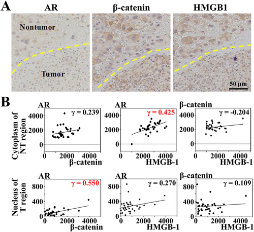 Figure 7 The correlations between the expressions of AR, β-catenin and HMGB1 in the cytoplasmic or nuclear regions of the non-tumor or tumor areas in liver samples of HCC patients.