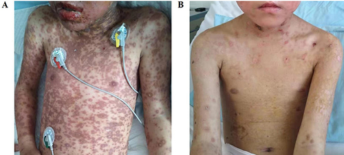 Figure 1 (A) The clinical image of the patient before treatment. (B) The clinical image of the patient after treatment.