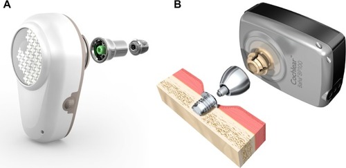 Figure 5 Bone-anchored hearing aid, a percutaneous direct-drive bone-conduction device.