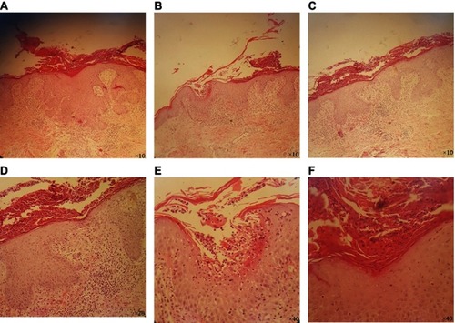 Figure 2 Histopathological view of lesion biopsy, acanthosis with elongation of rete ridges and thickening of lower portion, parakeratosis with perivascular infiltration of lymphoid cells (A–F).