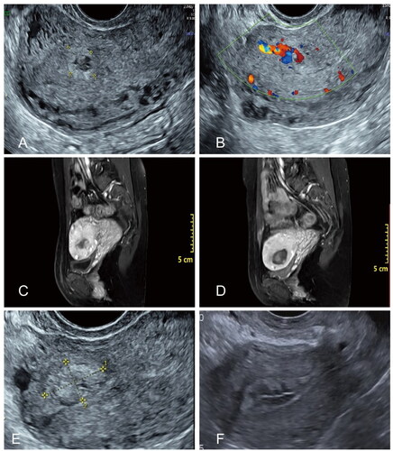 Figure 2. Image profile of a 33-year-old patient with UAVF. (A) Color Doppler ultrasonography of a longitudinal section of the patient’s uterus before HIFU treatment. (B) Color Doppler showed multicolored blood flow signals in the anechoic region. (C) The pre-HIFU MR image showed a lesion located at left anterior wall of the uterus. (D) The post-HIFU MR image showed no perfusion in the lesion located at the anterior wall of the uterus. (E) Ultrasound examination performed one month later showed no blood flow, with the lesion measuring 19 × 17 × 13 mm and a reduction rate of 57%. (F) Ultrasound image of the uterus 12 month after HIFU showed a relatively normal uterine cavity.