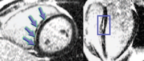 Figure 1. Late gadolinium enhancement of the left ventricular myocardium in left-dominant arrhythmogenic cardiomyopathy.Cardiovascular magnetic resonance images from a 19-year-old boy with a heterozygous chain termination mutation in desmoplakin. There is late gadolinium enhancement of the septum in a midwall distribution (arrows in left panel; box in right panel), likely representative of fibrous tissue. Ventricular volumes and function were normal and wall motion abnormalities inconspicuous, highlighting the importance of late gadolinium enhancement imaging in establishing the diagnosis. In this family, the majority of affected individuals had left-dominant arrhythmogenic cardiomyopathy, but the biventricular subtype was also present in a few.