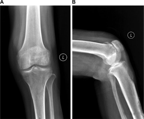 Figure 1 (A) Posteroanterior radiograph; (B) lateral radiograph confirming lytic destruction of the distal femur bone.