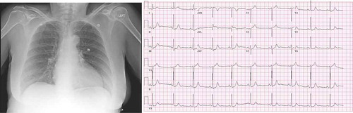 Figure 1. (a) CXR demonstrating pulmonary vascular markings with increased cephalization. (b) Electrocardiogram demonstrating normal sinus rhythm and no signs of ST-elevation or depression, no inverted T waves noted.