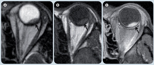 Figure 13. Globe metastatic lesion.(A) Axial T2-weighted image (WI), (B) T1-weighted and (C) T1-weighted fat-supressed postgadolinium MRI show a small lesion in the posterior and lateral aspect of the left globe (black arrow). (A) The lesion is hypointense on T2-WI and (B) hyperintense on T1-WI relative to the vitreous and (C) shows avid enhancement after contrast administration. There were no other lesions. Patient’s history of prior primary lung carcinoma suggested the correct diagnosis.