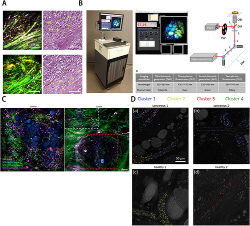 Figure 4 (A) Determination of phase of tumor cell invasion around desmoplasia by EVs distribution. (B) Intraoperative label-free multimodal imaging system. (A) and (B) Reprinted from Sun Y, You S, Tu H, et al. Intraoperative visualization of the tumor microenvironment and quantification of extracellular vesicles by label-free nonlinear imaging. Sci Adv. 2018. Creative Commons.Citation119 (C)In vivo visualization of EVs from cancer tissue in rat mammary tumors by label-free multiphoton microscopy. Reprinted from You S, Barkalifa R, Chaney EJ, et al. Label-free visualization and characterization of extracellular vesicles in breast cancer. Proc Natl Acad Sci U S A. 2019;116(48):24012–24018. Creative Commons.Citation120 (D) EVs cluster distribution in rat mammary tissues by K-means clustering of CARS spectra. Reprinted with permission from © The Optical Society. Sun Y, Chen EW, Thomas J, Liu Y, Tu H, Boppart SA. K-means clustering of coherent Raman spectra from extracellular vesicles visualized by label-free multiphoton imaging. Opt Lett. 2020;45(13):3613–3616.Citation121