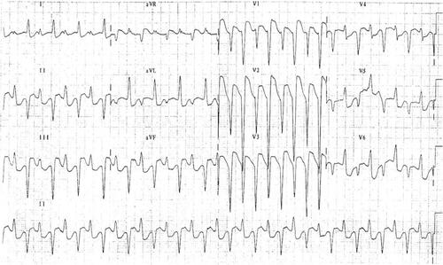 Figure 3 BiVT, QRS axis is alternating between right and left axis with each beat. Reproduced from Burns E, Buttner R. Bidirectional Ventricular Tachycardia (BVT). Available from: https://litfl.com/bidirectional-ventricular-tachycardia-bvt-ecg-library/. Creative Commons license and disclaimer available from: http://creativecommons.org/licenses/by/4.0/legalcode.Citation34