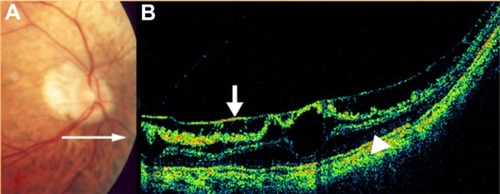 Figure 48 Myopic degeneration with retinoschisis.