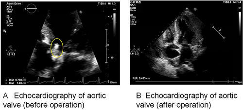 Figure 1 Echocardiography of aortic valve. (A) Echocardiography of aortic valve (before operation). Yellow circle: aortic coronal valve with a slightly elevated echogenic mass, with a cross-sectional size of approximately 7mm×15mm. (B) Echocardiography of aortic valve (after operation). Normal position and function of the biological valve are, no obvious perivalve leakage.