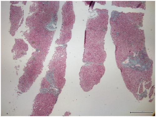 Figure 3. There is portal fibrous enlargement and septae formation (Masson trichrome ×100).