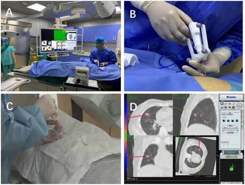 Figure 3. ( A) Position layout of the optical navigation system in the CT room. (B,C) With the assistance of optical and electromagnetic navigation, the interventional doctor performed the puncture operation. The virtual real-time 3D monitoring display screen of the (D) navigation system can simulate the specific position of the probe.