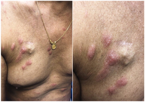 Figure 1. Clinical presentation with presence of pink oedematous pseudovesiculated plaques on the trunk.