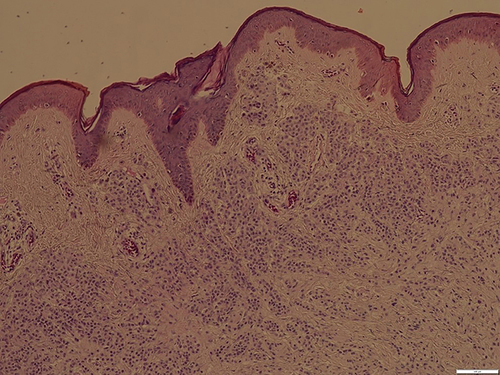 Figure 2 The epidermis mutated flat disappeared, the pigment granules in the basal layer were obvious, and numerous lymphocytes infiltrated around the blood vessels in the superficial dermis (HE, ×100).