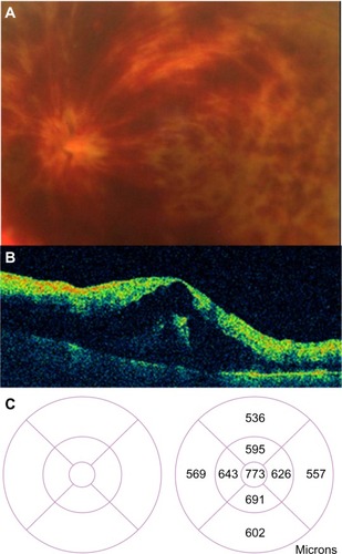 Figure 46 Acute central retinal vein occlusion with macular edema.