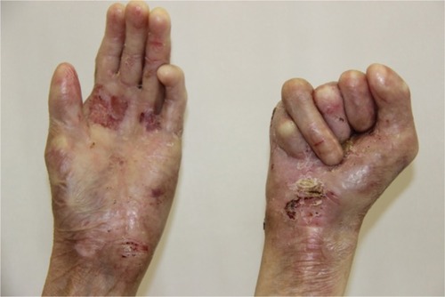 Figure 4 Appearance of deformities on the patient’s hands on presentation.