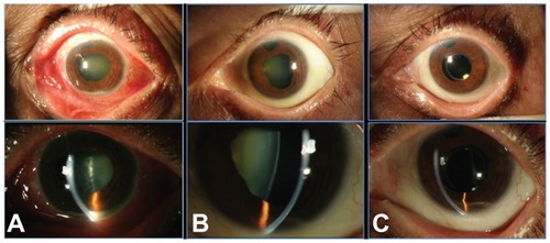 Figure 2 Patient 7, a 72-year-old female with history of glaucoma filtering surgery OS 8 months prior to presentation. (A) Slit lamp at presentation. Visual acuity 20/400. Culture positive for Moraxella species. (B) Slit lamp 2 months after presentation. Patient treated with intravitreal vancomycin, ceftazidime, and dexamethasone. Visual acuity 20/25. (C) Slip lamp 22 months after presentation, 4 months after uncomplicated phaco/intraocular lens implantation OS. Visual acuity 20/25.