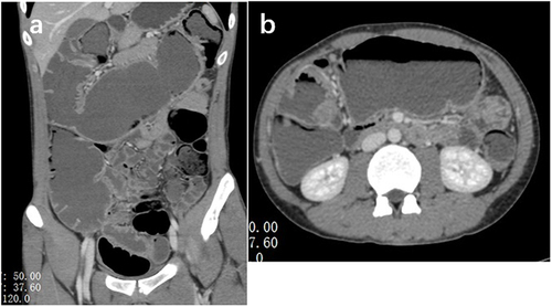 Figure 1 (a and b) Abdominal CT scan indicates gas and fluid accumulation inside the colon and small intestine.
