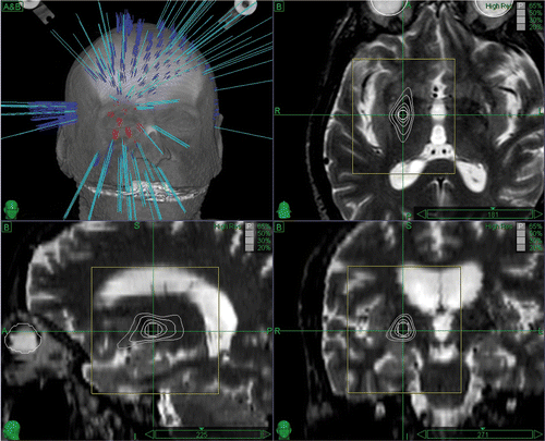 Figure 2. The 3D beam distribution (upper left) and the axial (upper right), sagittal (lower left) and coronal (lower right) views of the pallidotomy case treatment plan visualized on the patient T2-weighted MRI volume.