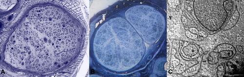 Figure 2 Sural nerve biopsies from a patient with late-onset FAP. Semithin sections stained with toluidine blue showed a severe reduction of myelinated fibres (A). A second biopsy performed four years later revealed complete loss of myelinated fibres (B), while unmyelinated fibres were relatively preserved (C).