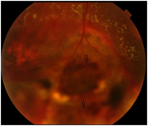 Figure 6 Fundus photograph of the left eye 5 weeks after presentation.