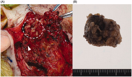 Figure 2. Intraoperative finding and resected specimen. Arrowheads indicate the main trunk of the facial nerve at the cross point (A). The upper end of tumor (white dotted circle) invaded the zygomatic branch of facial nerve. The surgical specimens were whitish in color (B).