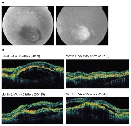 Figure 4 An 80-year-old male patient with a disciform scar in the right eye received prior photodynamic therapy with verteporfin and 3 injections of bevacizumab. A) Fluorescein angiography. B) Optical coherence tomography images and visual acuity (VA; Early Treatment Diabetic Retinopathy Study [ETDRS] letters) at baseline and months 1, 3, and 6.