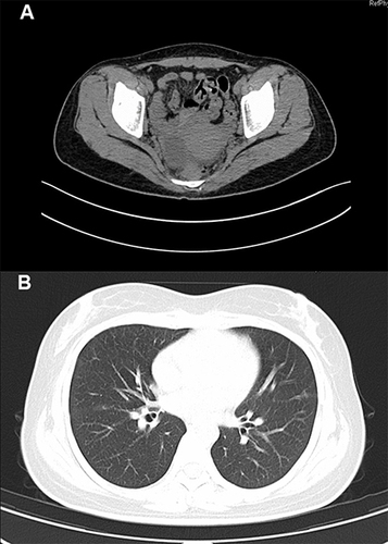 Figure 1 Abdominal CT revealed multiple cystic foci in the adnexa bilaterally (A). Chest CT showed scattered striated foci in both lungs with thickening of some lobular septa (B).