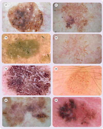 Figure 23. Vascular pattern with hairpin vessels