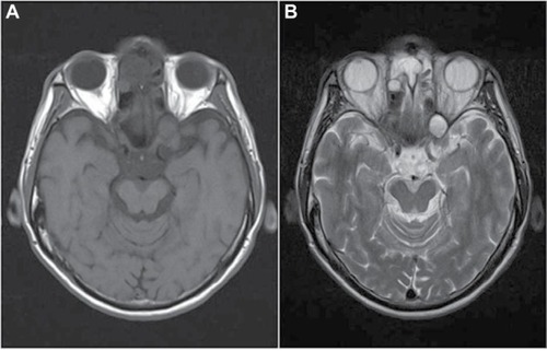 Figure 2 MRI of brain and orbits showed a discrete nodule of low T1 (A) and high T2 (B) signals at the left orbital apex, compressing the superior rectus muscle and optic nerve. Incidental finding of right ethmoidal cystic lesion; possibly, a mucocele was noted in this imaging.