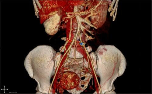 Figure 3 3D reconstruction of the CT venogram shows compression of the left iliac vein (blue arrow) by the right iliac artery (red arrow) at the level of the 4th lumbar vertebra (L4).
