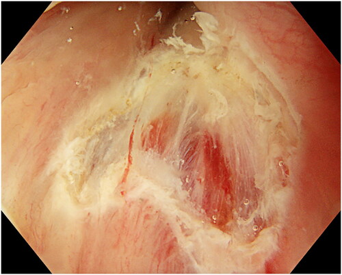 Figure 4. Resection of the lesion. The lesion is retrieved and sent for histopathology. Minor bleeding can be coagulated with the top of the snare. In case of uncertainty about radical resection, the edges can also be coagulated.