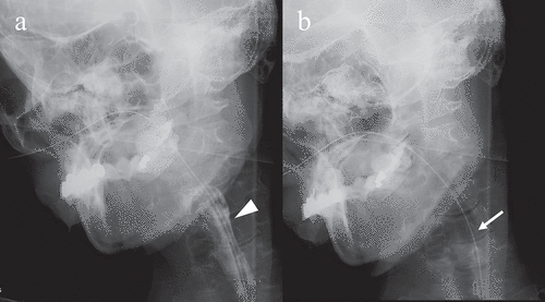 Figure 2. Videofluoroscopic examination of swallowing (VF) of the patient. VF of the patient in frontal view acquired 68 months after the onset of symptoms. (a) Once the swallowing reflex was triggered, the bolus passed through the pharynx into the upper oesophagus (arrowhead). (b) Pharyngeal residue or aspiration was not observed after swallowing (arrow)