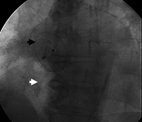 Figure 2 Implanted 26 mm Amplatser ASD occluder (black arrow) and 3.0×12 mm Driver coronary stent (white arrow).