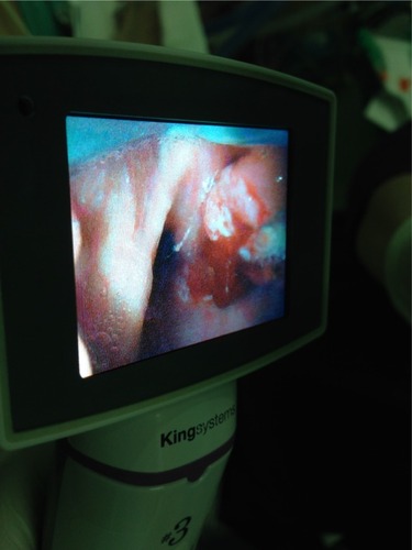Figure 1 Picture of visualization of the tumor obscuring the entrance to the larynx using the KingVision™ video laryngoscope (King Systems, Noblesville, IN, USA).