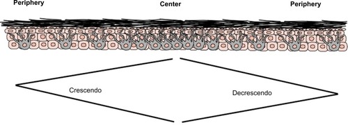 Figure 2 Evaluation of bread-loafed cross-sections of peripheral margins allows for comparison of the background increased density of melanocytes, reflective of chronic sun damage (at the periphery), with area of lentigo maligna (at the center).