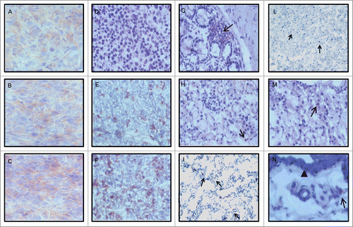 Figure 3. Modulation of MHC class I antigen expression and T cell infiltration by 5-AZA-CdR combined with mAb 9H10 in the syngeneic TS/A mouse tumor model. BALB/c mice were inoculated sc with 2 × 105 TS/A cells. Groups of 5 mice were injected ip with 5-AZA-CdR; with mAb 9H10; with combined administration of 5-AZA-CdR and mAb 9H10 according to the above reported schedules, or with saline solution for control. A week after the end of treatment, neoplastic and normal tissues were excised and snap frozen in liquid nitrogen. Four micron acetone-fixed cryostat sections were processed for IHC assays. Representative results from tumors (A–F) and normal tissues (G–N) are reported. (A– C): MHC class I staining of tumors from mice treated with saline solution, with mAb 9H10 or 5-AZA-CdR, respectively; (D– F): CD3 staining of tumors from mice treated with saline solution, with mAb 9H10 or the combination of 5-AZA-CdR and with mAb 9H10, respectively; (G–I and L–N): CD3 staining of glandular epithelium of large intestine, liver, lung, myocardium renal parenchyma and dermis from mice treated with mAb 9H10 or 5-AZA-CdR, respectively. (A–F), 200× magnification, (G–M), 160× magnification; (N), 250× magnification. The arrowed marks the dermal-epidermal junction; black arrows, CD3+ lymphocytes.