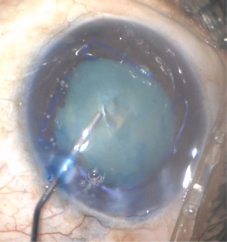 Figure 3 Ophthalmic viscosurgical device injected into the capsular bag and anterior chamber.