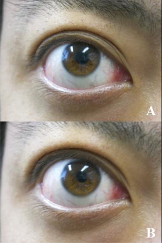 Figure 1 Double motion sign of the upper eyelid. A) Upper eyelid partially covers the upper part of the cornea on a slight upward gaze. B) The upper eyelid is still in the same position, but the eye moves downward, exposing the sclera between the upper eyelid and the cornea.