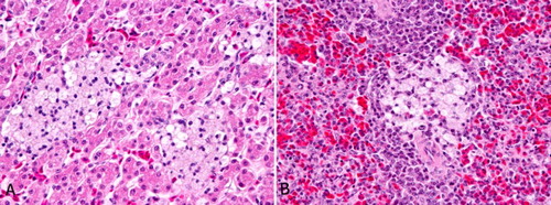 Figure 2. (A) Emu 2, sibling to index case, MPS IIIB, liver. Numerous focal aggregates of foamy macrophages are randomly scattered throughout the liver. (B) Emu 2, sibling to index case, MPS IIIB, spleen. Occasional foci of foamy macrophages like those in the liver are present in the spleen.