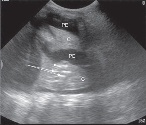 Figure 4. Parallel air bronchogram (arrows) within the pulmonary consolidation (C) of passive atelectasis due to large amount of pleural effusion (PE).