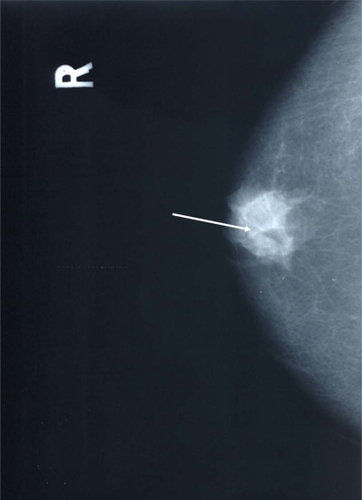 Figure 2 CC view (arrow indicates microcalcification).